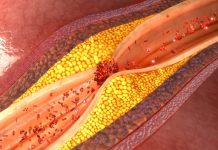 Amgen’s Repatha cholesterol shot slashed heart attack risk by 36%